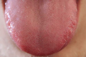 舌ピアスは塞がりやすい？